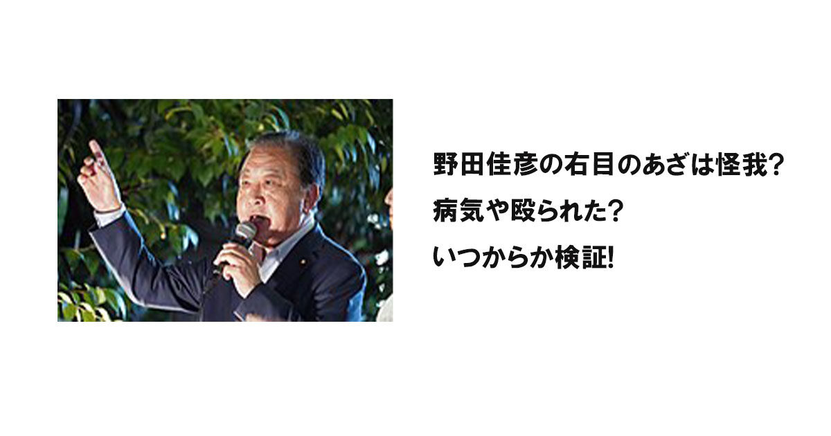 野田佳彦の右目のあざは怪我?病気や殴られた?いつからか検証!